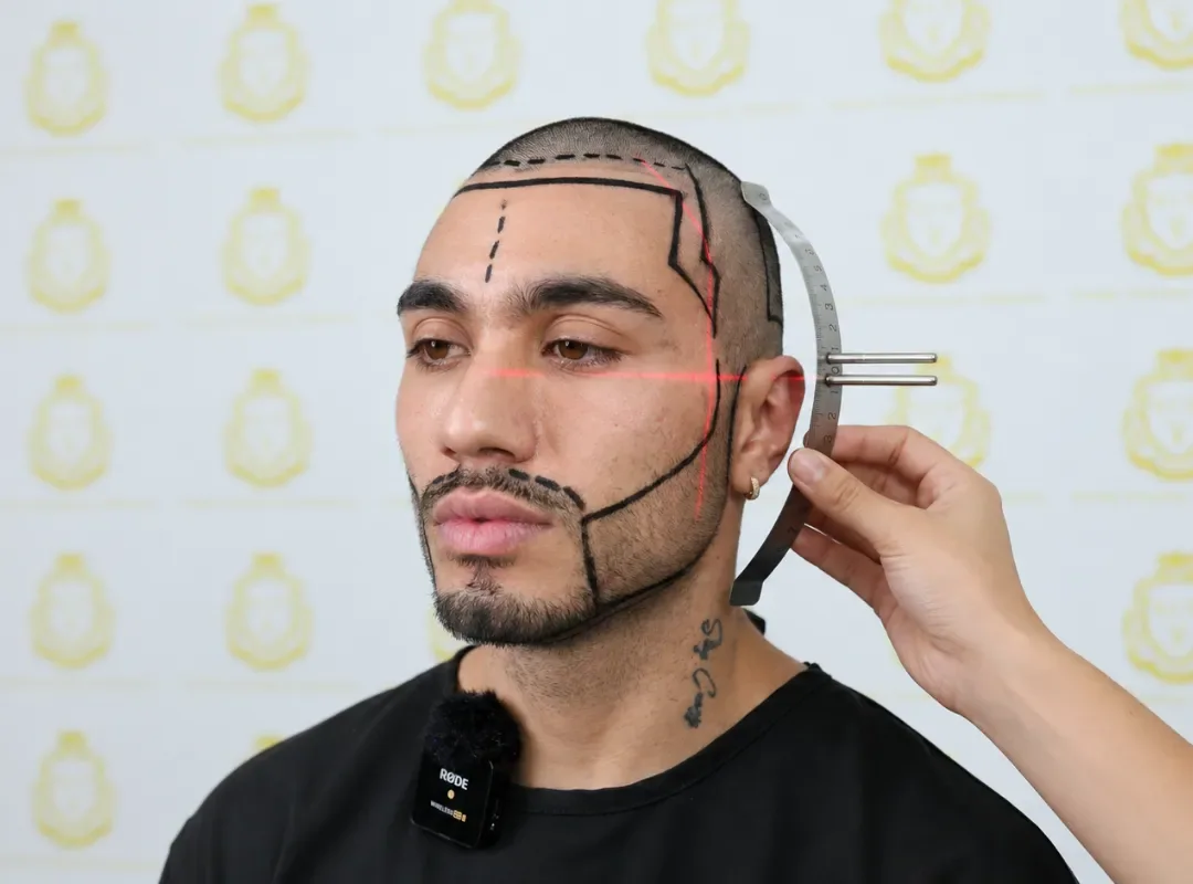 Hairline being measured and drawn on a patient before a hair transplant